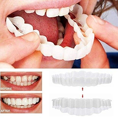 🎉50% OFF🎉 SMILE SNAP-ON BRACES