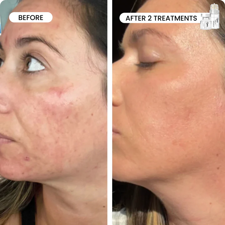 🔥HOT🔥2025 Micro-Infusion 2 Month Bundle (For Dark Spots)