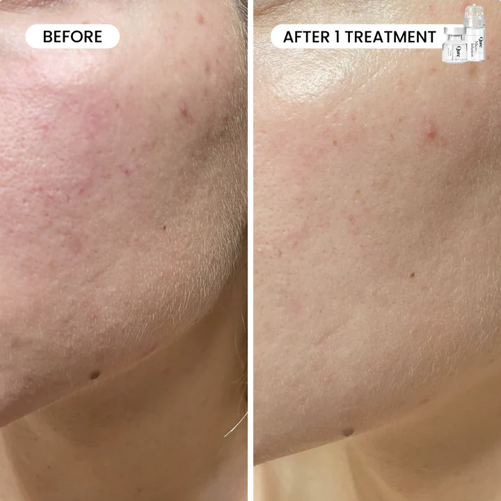 🔥HOT🔥2025 Micro-Infusion 2 Month Bundle (For Dark Spots)