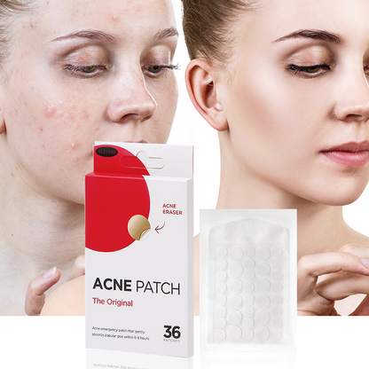 🔥BUY 1 GET 1 FREE - 72 PCS Acne Patch