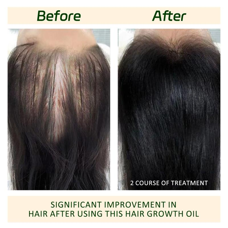 🔥BUY 1 GET 1 FREE🔥Hair Growth Oil