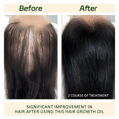 🔥BUY 1 GET 1 FREE🔥Hair Growth Oil