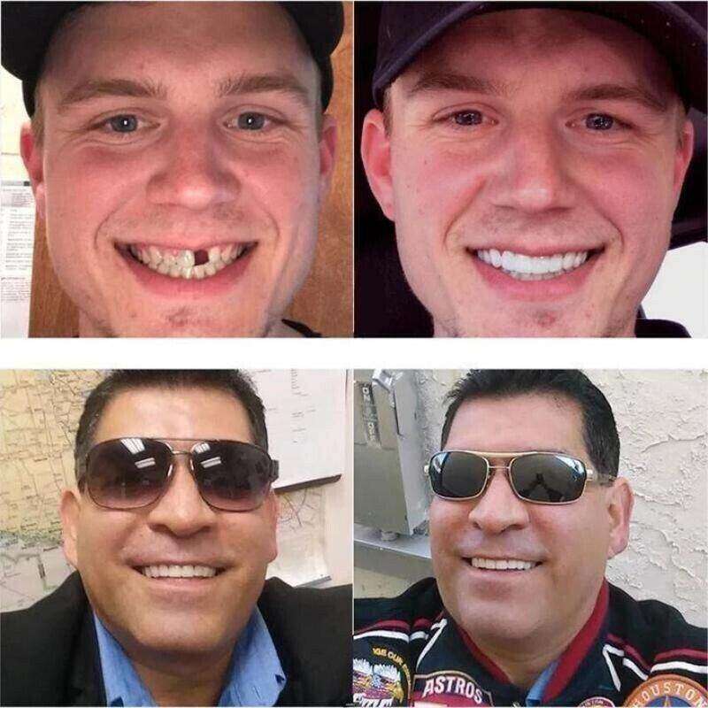 (😍Summer sale - 🔥50% off) Snap On Smile Veneers 😁 recommended by German doctor dentist👨‍⚕.