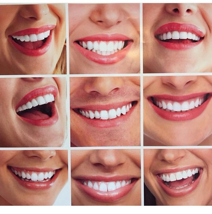 🎉50% OFF🎉 SMILE SNAP-ON BRACES