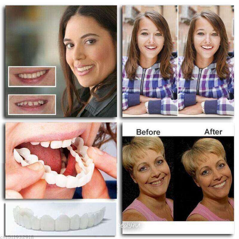 (😍Summer sale - 🔥50% off) Snap On Smile Veneers 😁 recommended by German doctor dentist👨‍⚕.