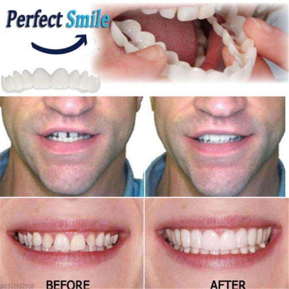 (😍Summer sale - 🔥50% off) Snap On Smile Veneers 😁 recommended by German doctor dentist👨‍⚕.
